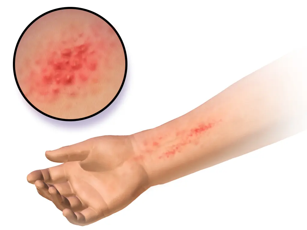 A medical illustration of an allergic contact dermatitis rash on the inner wrist, where a watch strap sits, with a magnified view of the skin