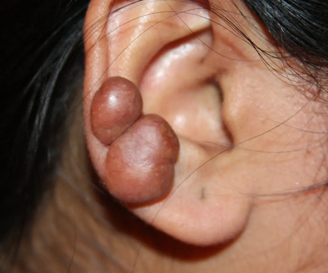Two keloid growths on the cartilage of an ear, each far larger than the wound that started them