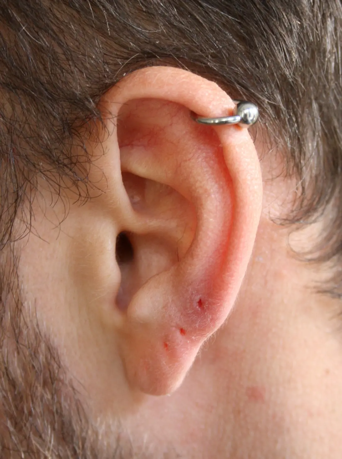 A captive bead ring through the upper helix rim of an ear
