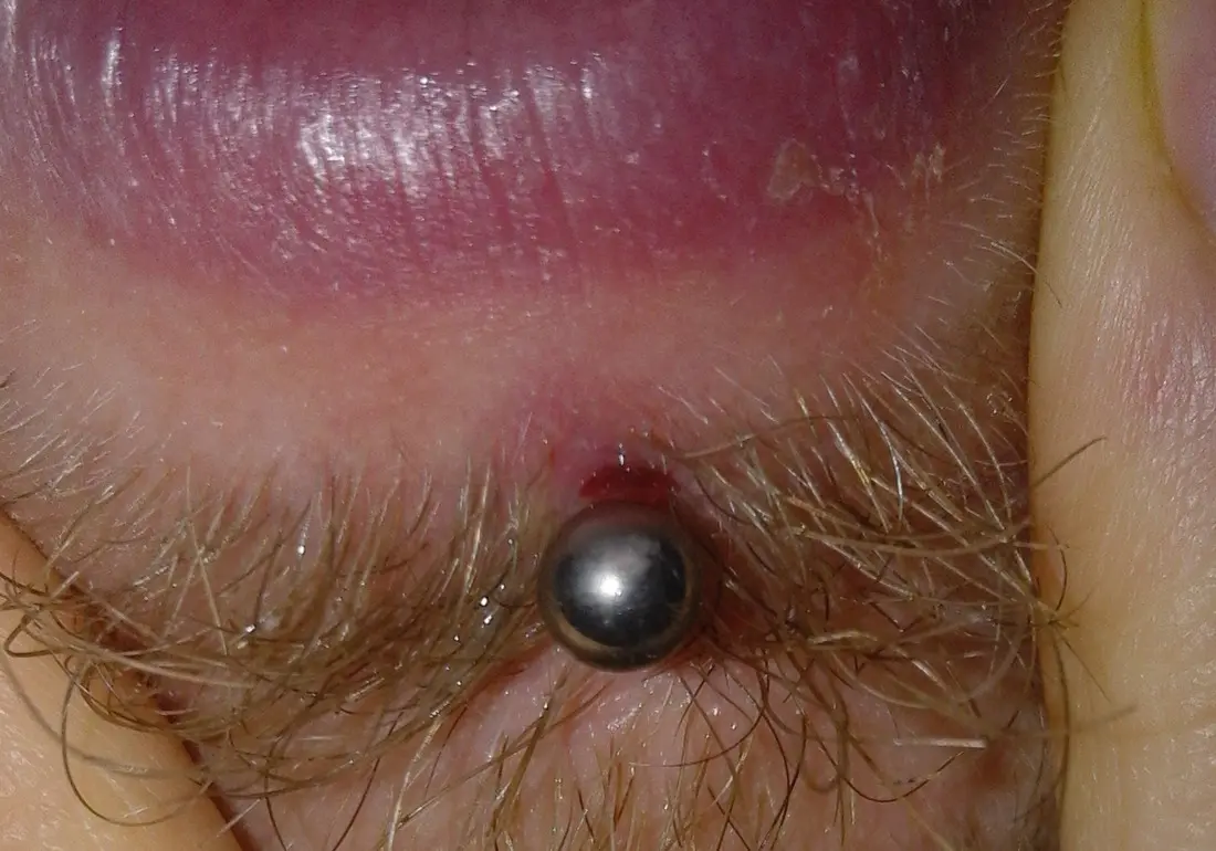 A small raised red scar beside a lower-lip labret stud, photographed seven weeks after the piercing was done