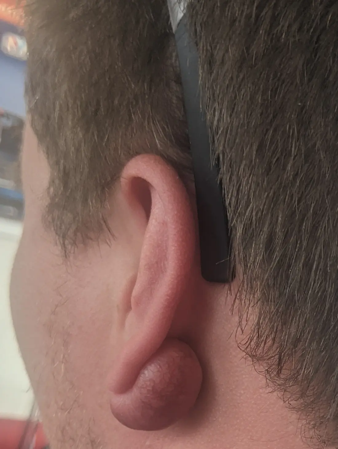 A keloid on an earlobe: a smooth, firm growth that has spread well beyond the original wound