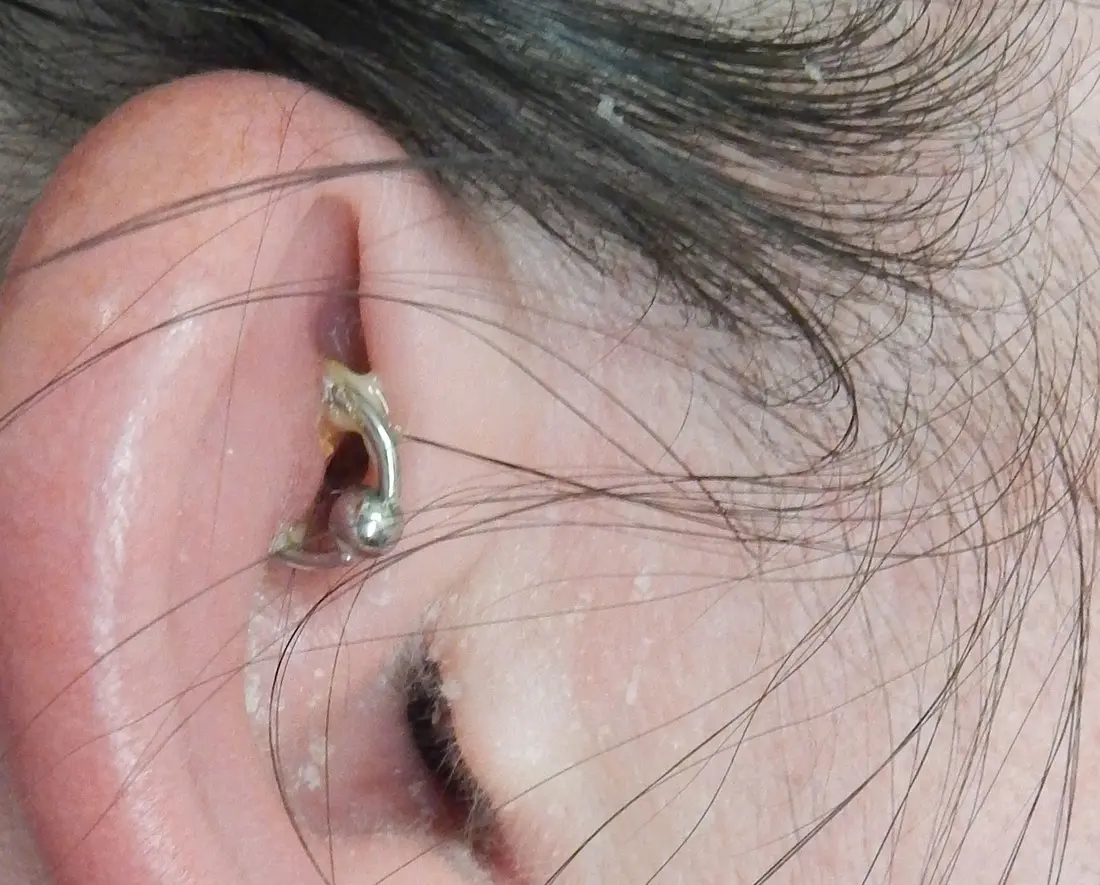 An ear with the jewelry still in place, showing the redness, swelling and yellow crusting of perichondritis, an infection of the cartilage